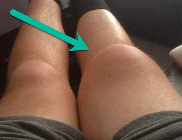 Swollen knees with an arrow pointing to one
